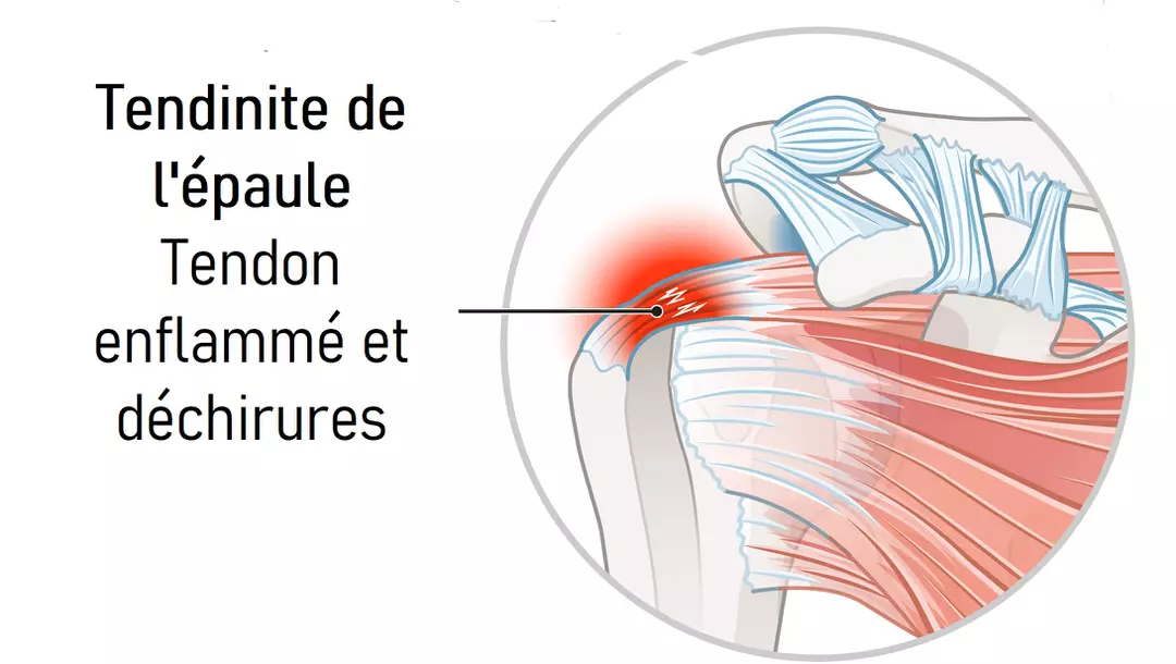 Tendinopathie non rompue de la coiffe des rotateurs — free download